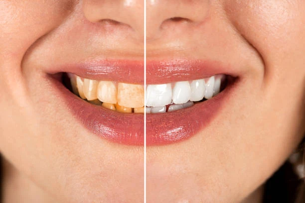 Is a Smile Makeover Worth It? Here’s What to Know