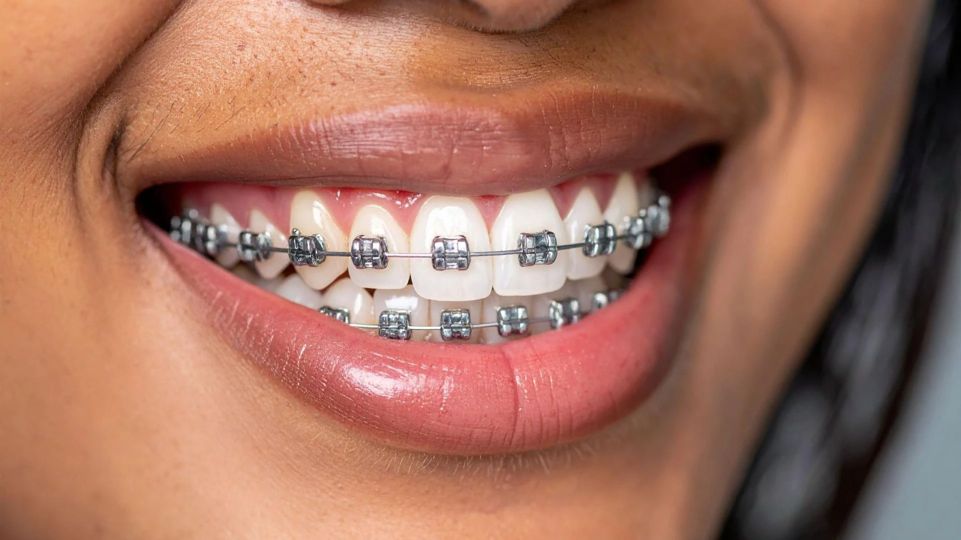 Nervous About Braces? What to Expect at Your Orthodontic Consultation in Garden Grove