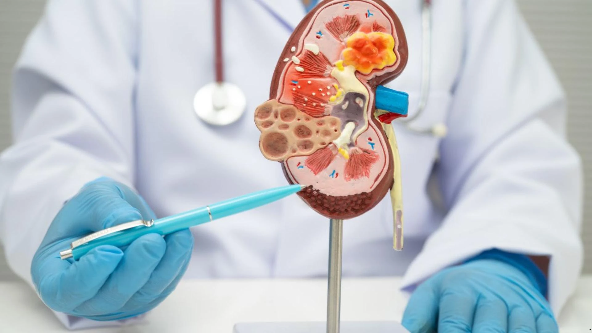 Understanding Chronic Kidney Disease: Causes, Symptoms, and Care