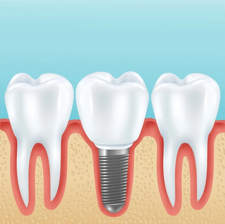 Your Guide To Quality Dental Implants In Chennai