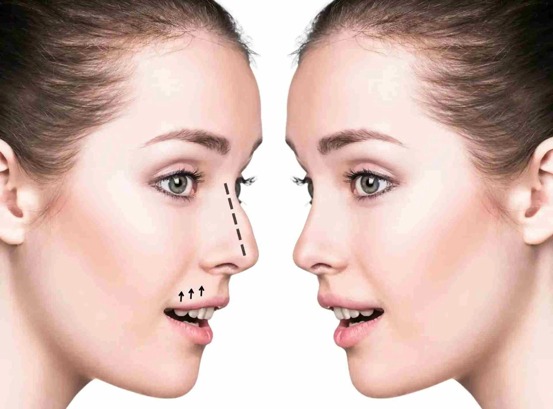 How Does the Best Rhinoplasty Surgeon in Dubai Plan Cases?