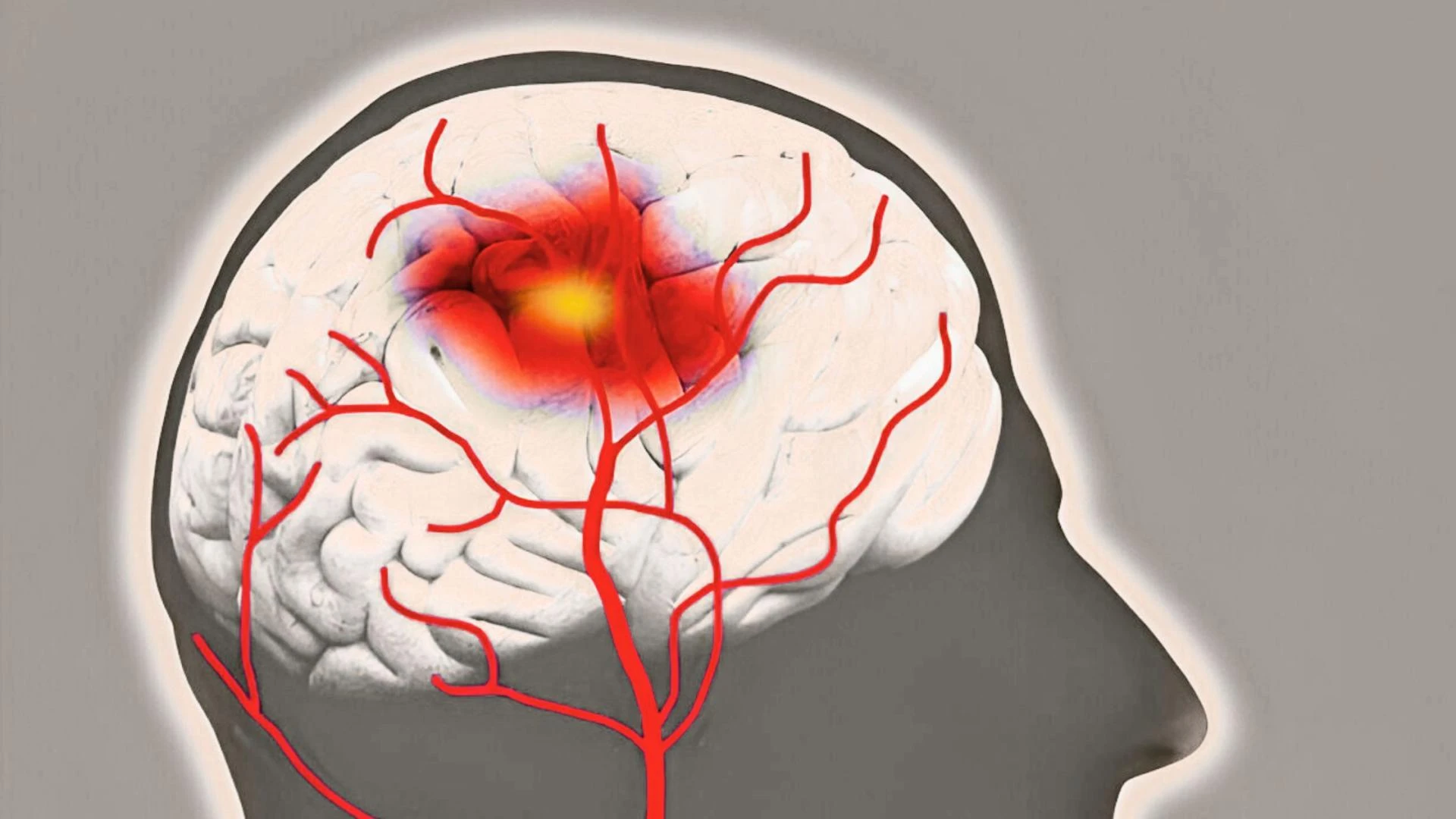 Stroke Recovery and Rehabilitation: What to Expect After a Stroke