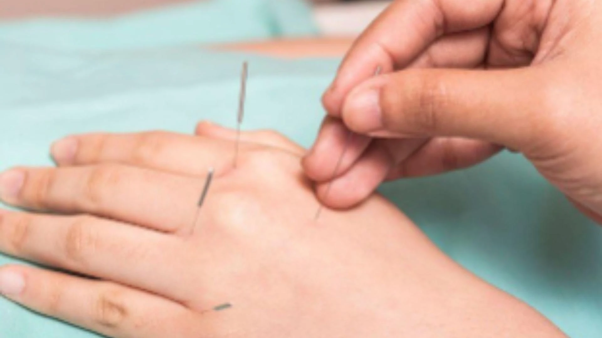 What Are the Top Benefits of Hand Acupuncture for Treating Chronic Hand Pain?