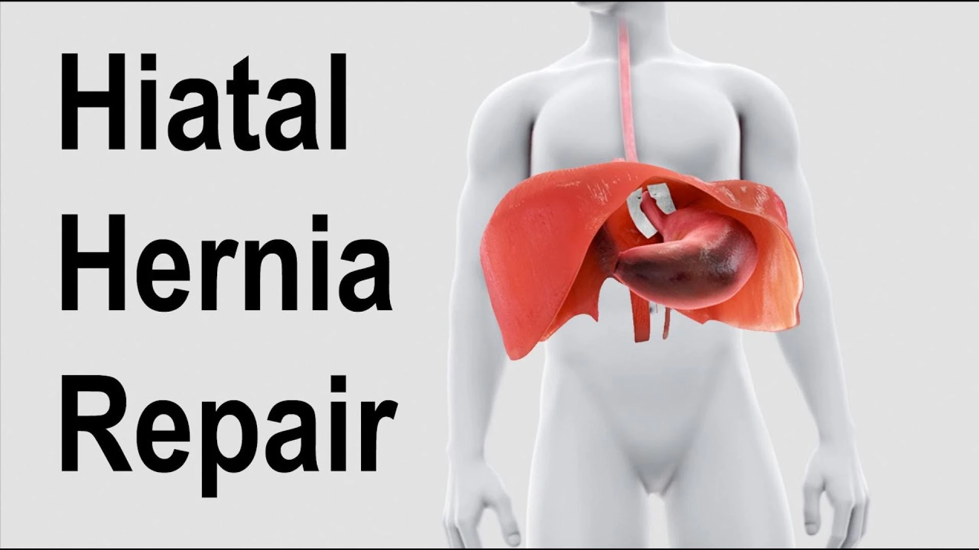 Preparing for Hiatal Hernia Repair Surgery: The Ultimate Tips