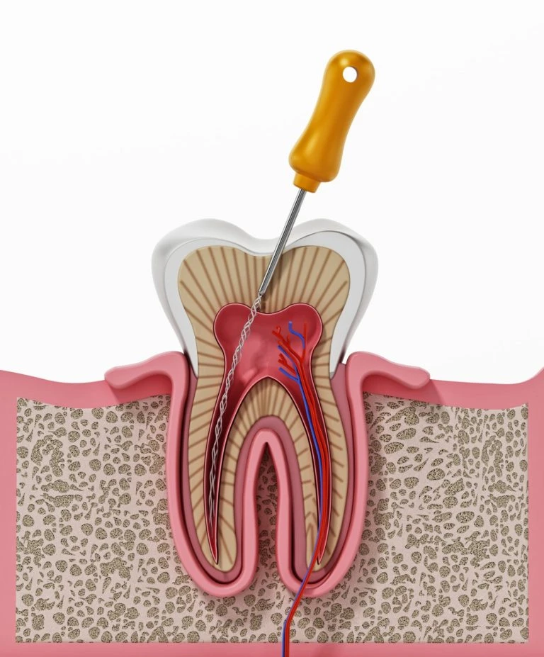 How a Root Canal Treatment Specialist Can Save Your Smile