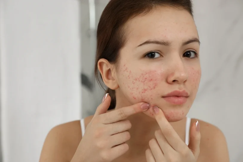 Ayurvedic Approach to Managing Skin Diseases Naturally