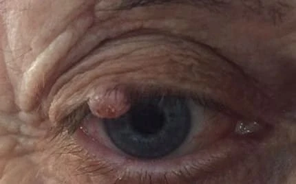 7 Conditions an Oculoplastic Surgeon Can Treat