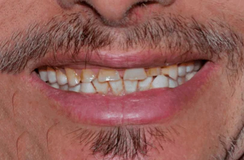 How Much Does a Dental Crown Cost in Tijuana? 