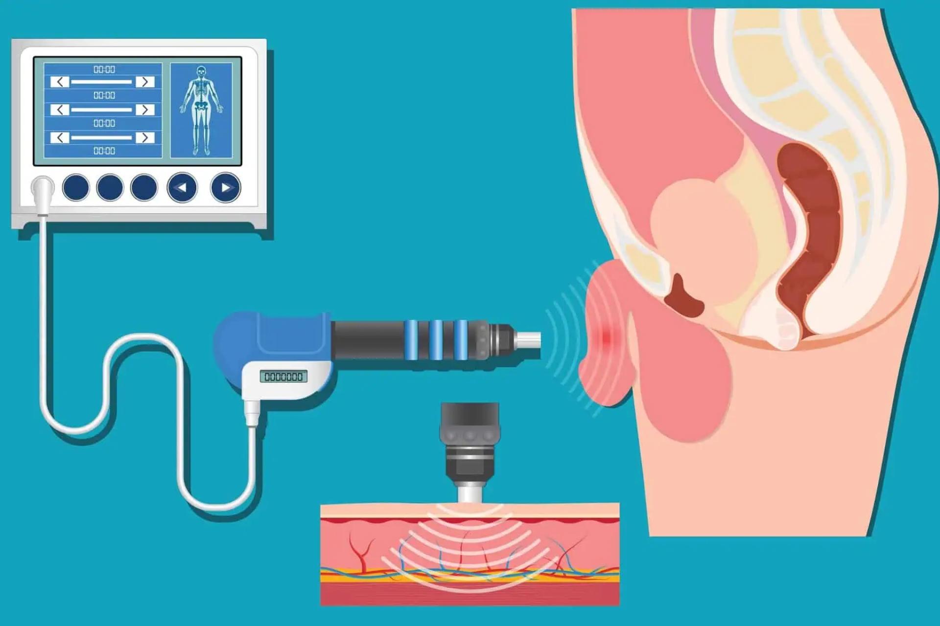 Using Prostate Suppositories Effectively: A Comprehensive Guide