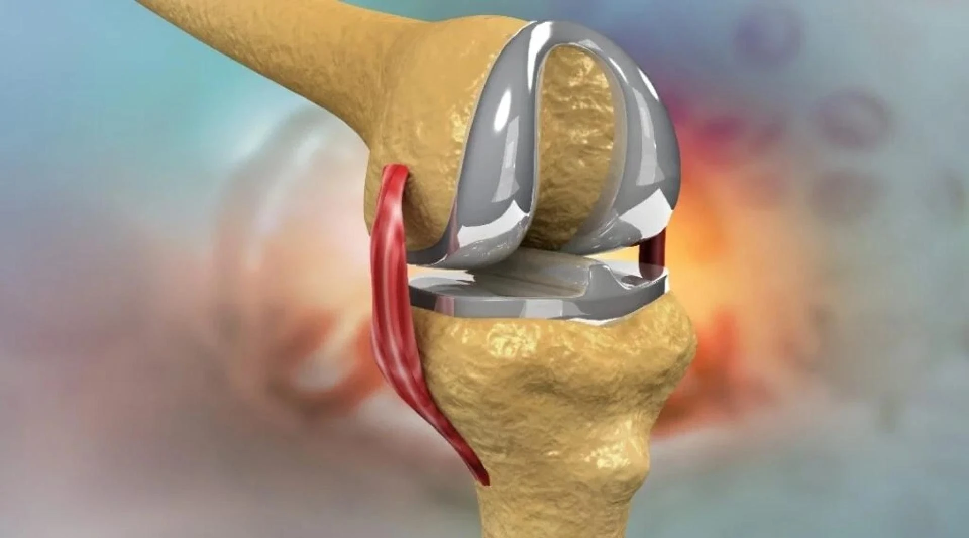Advanced Types of Partial Knee Replacement Surgery Delhi: Modern Solutions for Knee Arthritis