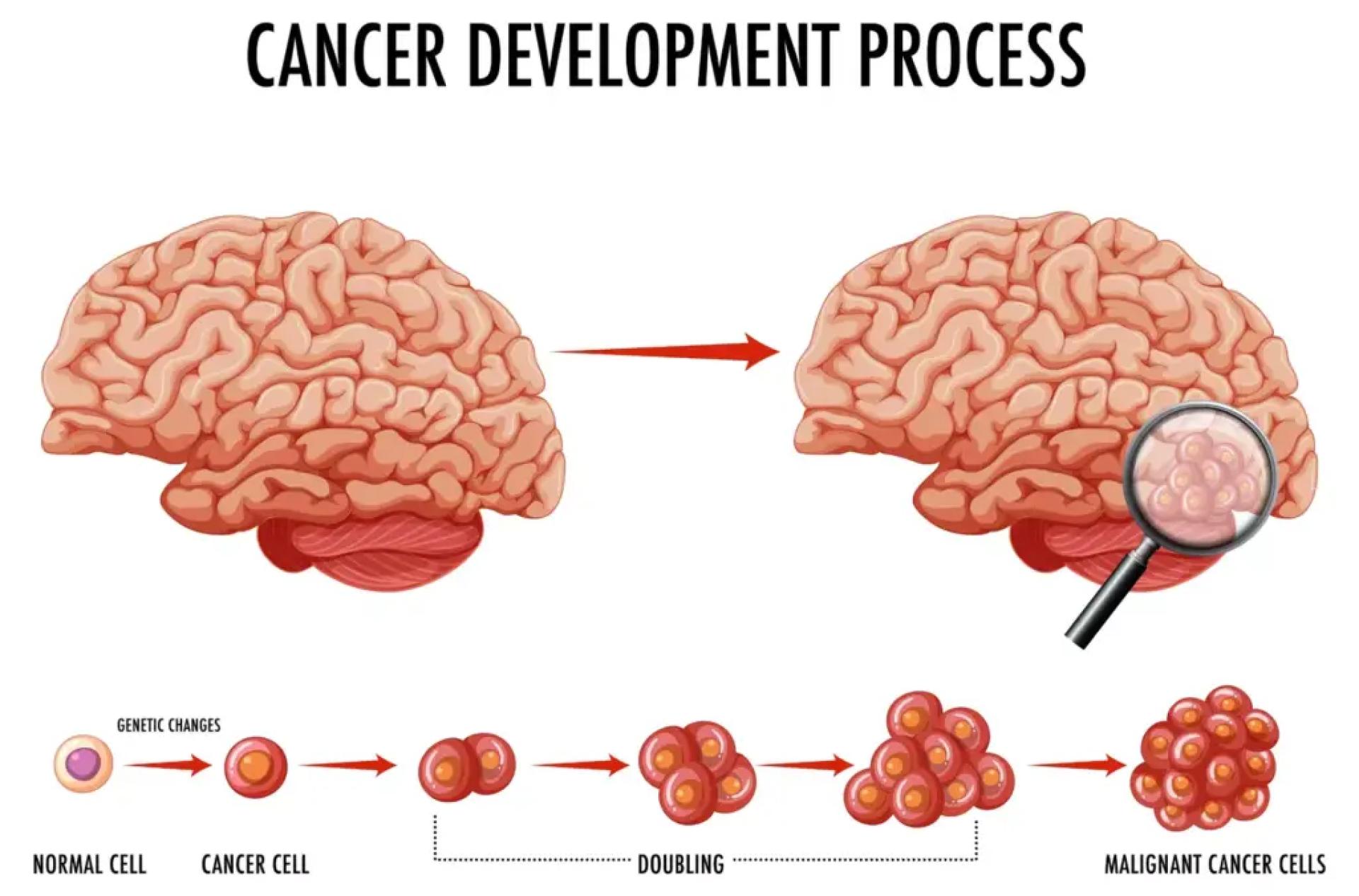 Brain Cancer vs. Astrocytoma: How Tumor Grades Define the Difference  