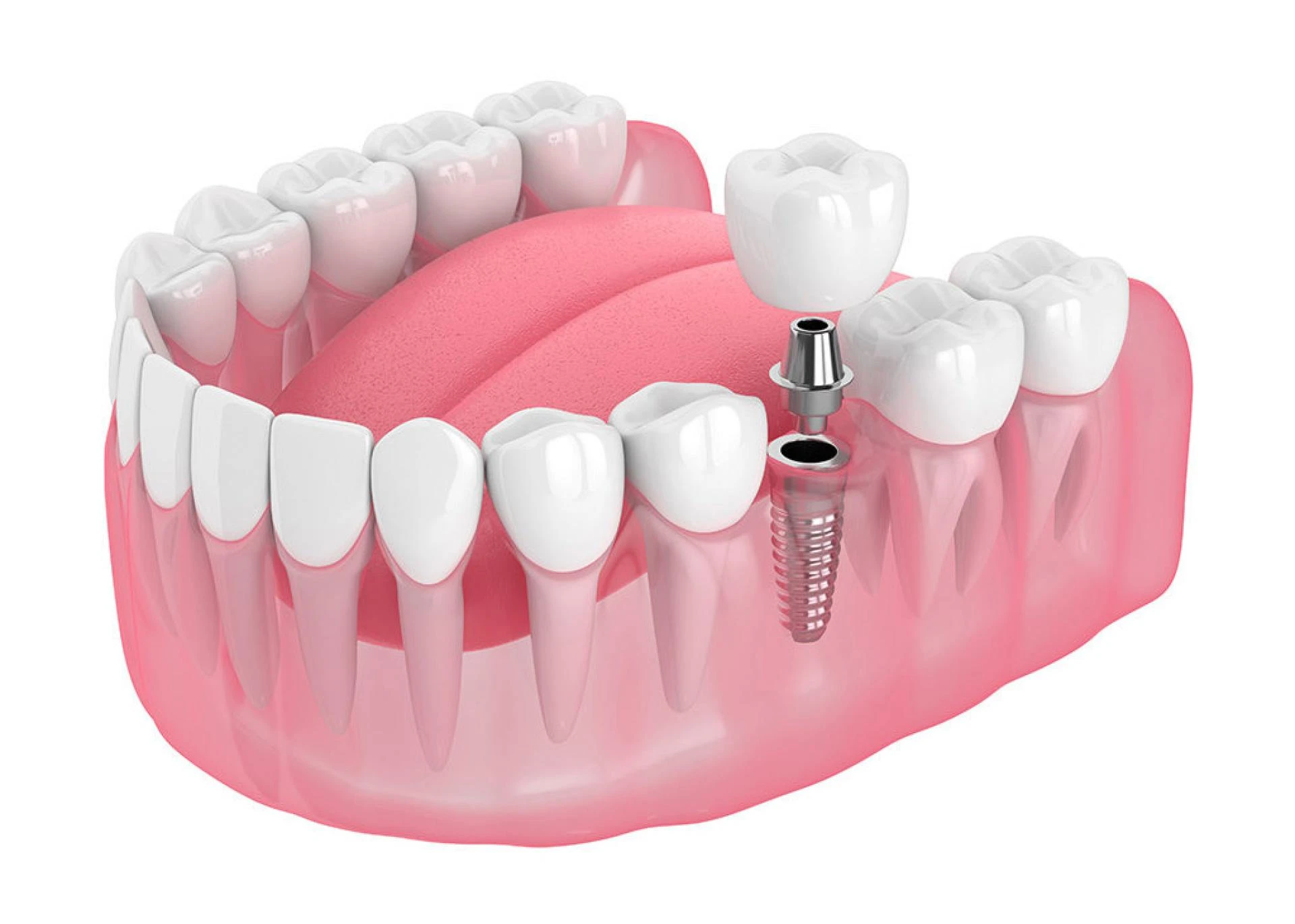 8 Questions to Ask Before Getting Dental Implants