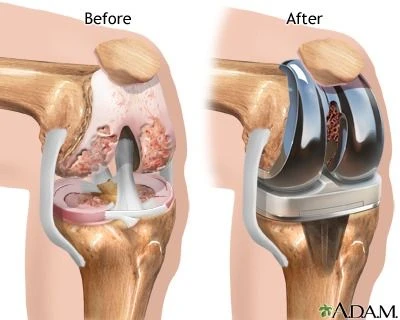 Robotic Knee Replacement Surgery: Cost, Success Rate & Recovery Time