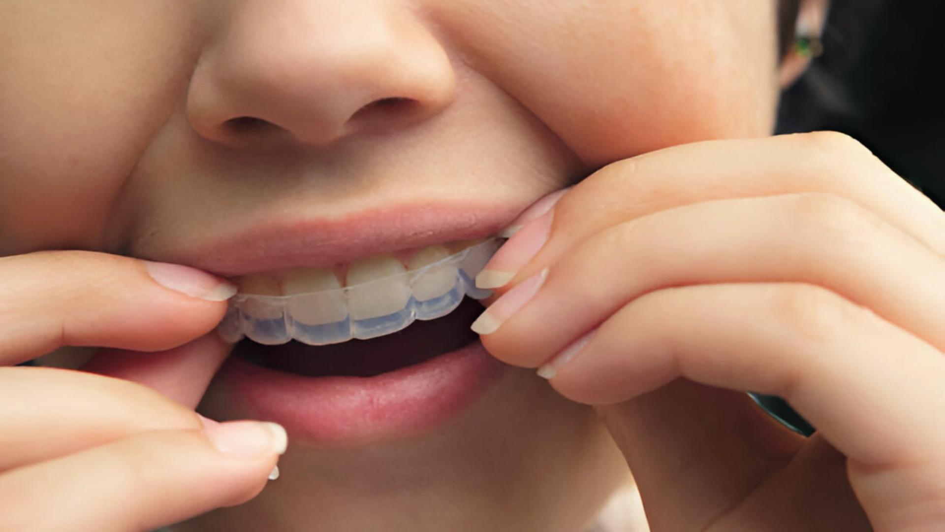 How to Clean Clear Aligners Properly: A Complete Guide for Better Oral Hygiene