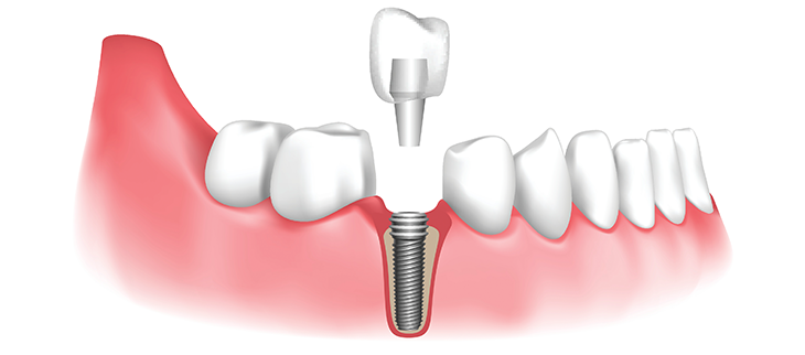 All-on-4 Dental Implants Turkey: A Practical Solution for Patients Needing a Full Smile Restoration