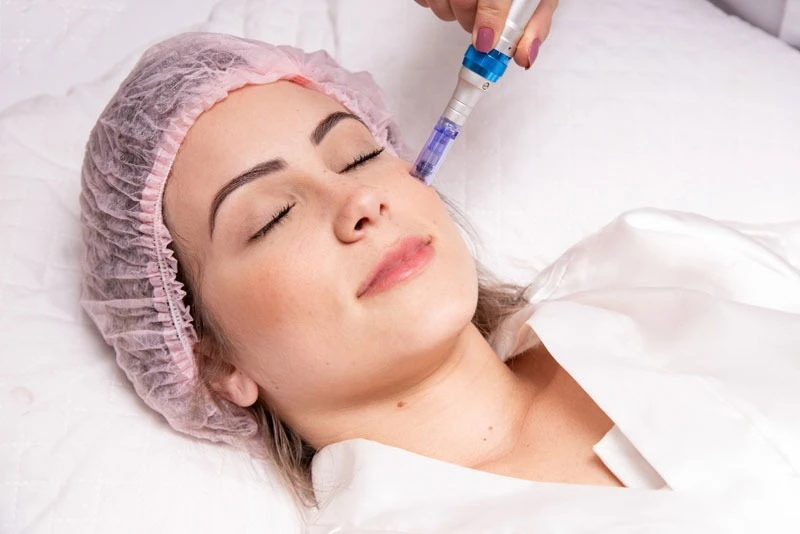 Microneedling Treatment in Delhi : How It Works, Benefits, Results and Side Effects