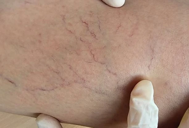 Quick Recovery Guide: Spider Veins Treatment in Dubai 2026