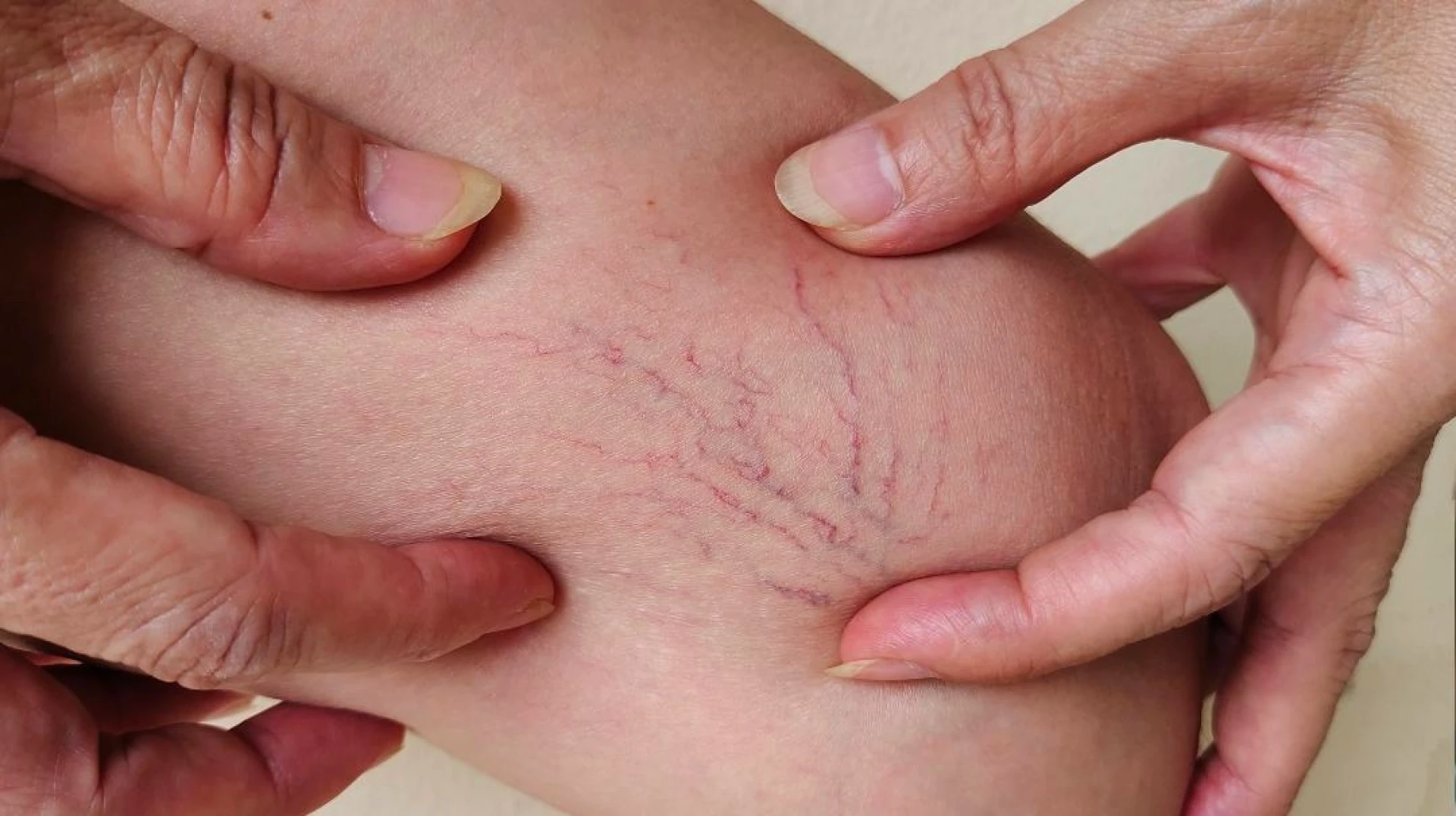 Why Early Vein Care Matters for Long-Term Leg Health