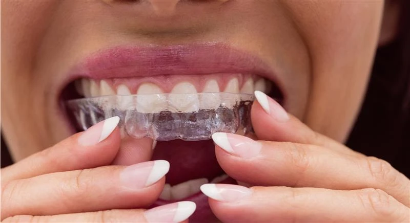 How Clear Aligners Can Fix Several Dental Issues