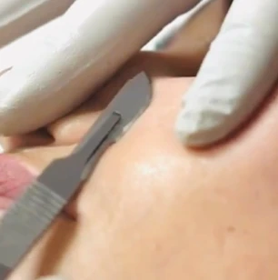 Is Dermaplaning Really Good for Your Skin?
