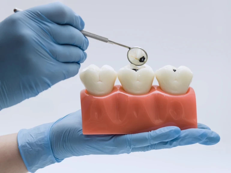 Is Sugar the Only Cause of Cavities? Surprising Facts Explained