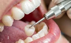 Dental Crowns in Turkey: Restoring Teeth While Enjoying a Stay in Antalya