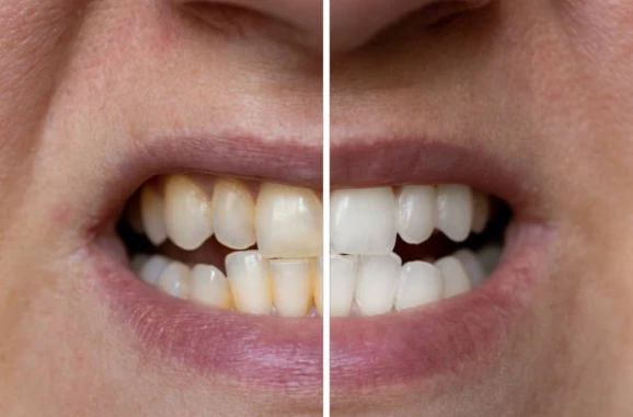 Teeth Whitening: Safe Methods, Benefits, and How to Maintain a Brighter Smile