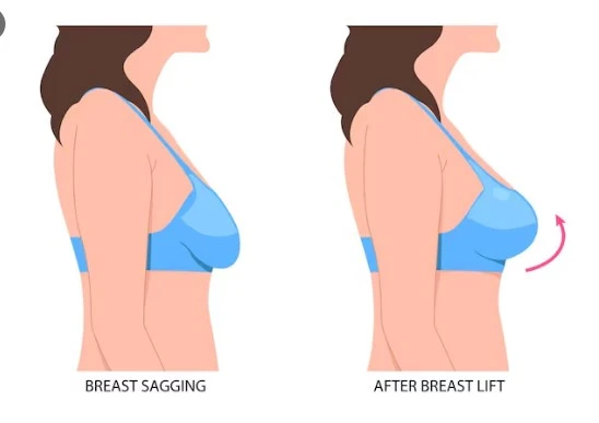 How to Find Affordable Breast Lift Price in South Africa Without Compromising Quality