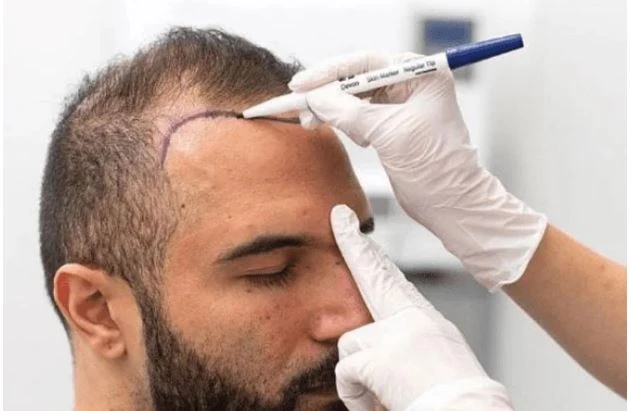 How Hair Transplant Techniques Have Improved in the UK Over the Last Decade