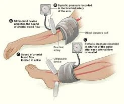 Peripheral Arterial Disease (PAD): Early Signs, Causes, and Effective Treatment Options