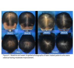 Laser Hair Treatment for Hair Loss: A Modern, Non-Invasive Solution