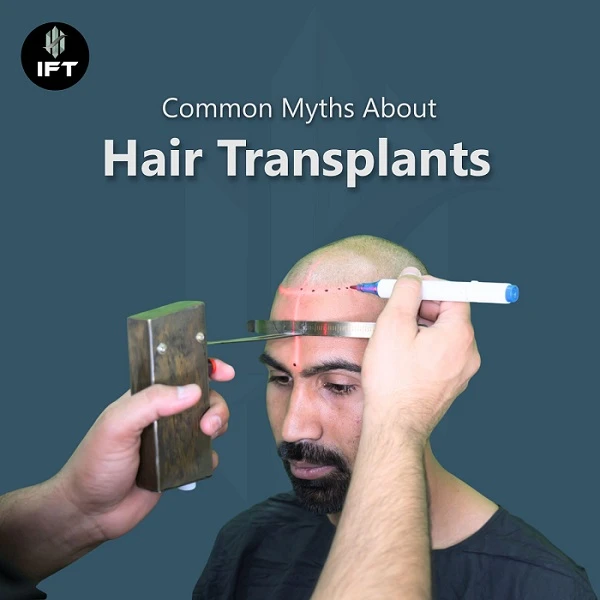Common Myths About Hair Transplants