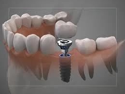 A Guide to Teeth Straightening Near Slough With Modern Solutions