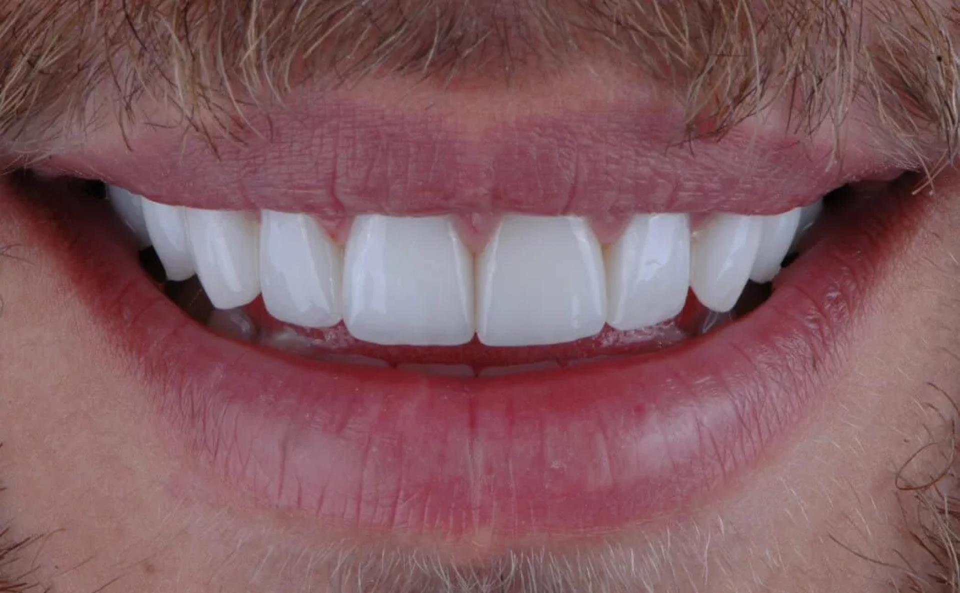 When Are Veneers the Right Choice for Smile Enhancement in Miami?