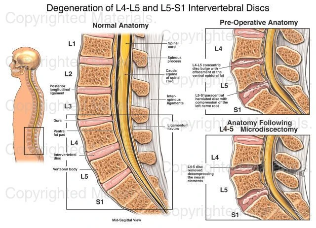L5-S1 Disc Bulge Explained: Symptoms, Causes, and Recovery Guide
