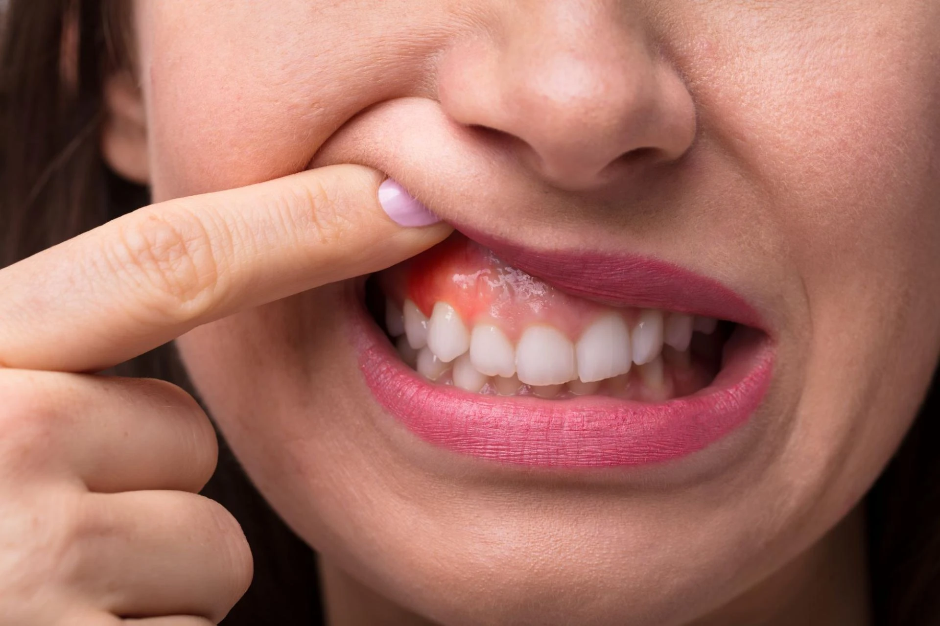 What Causes Tooth Sensitivity and How Can It Be Treated?
