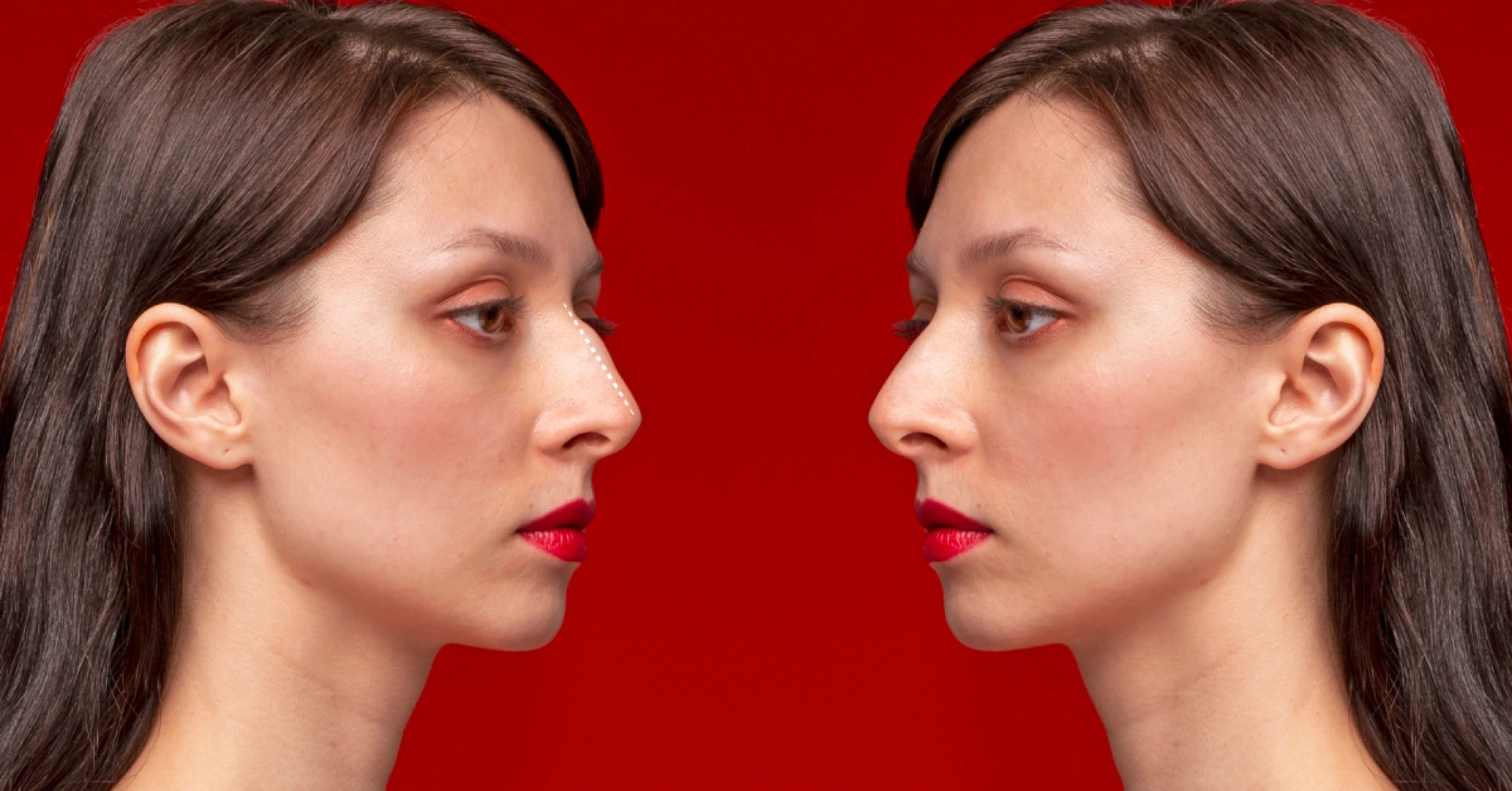 Nose Augmentation Before and After: Realistic Results and Healing Timeline