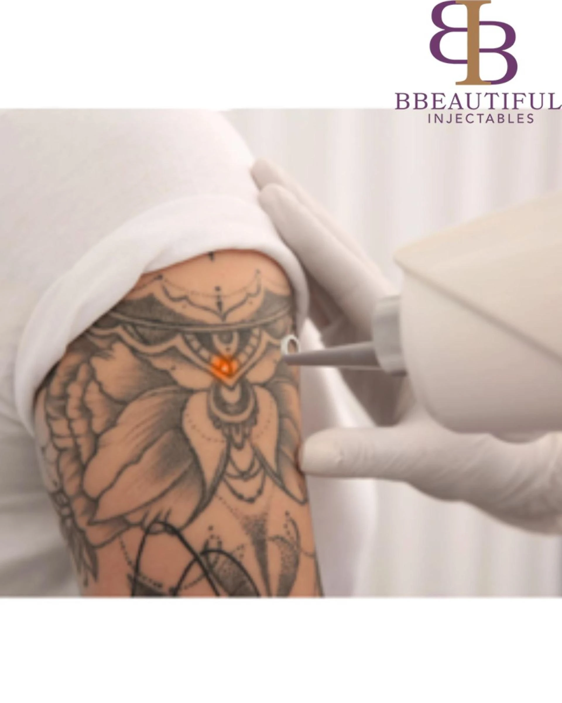 The "Frosting" Effect: What Your Skin is Doing During Tattoo Removal