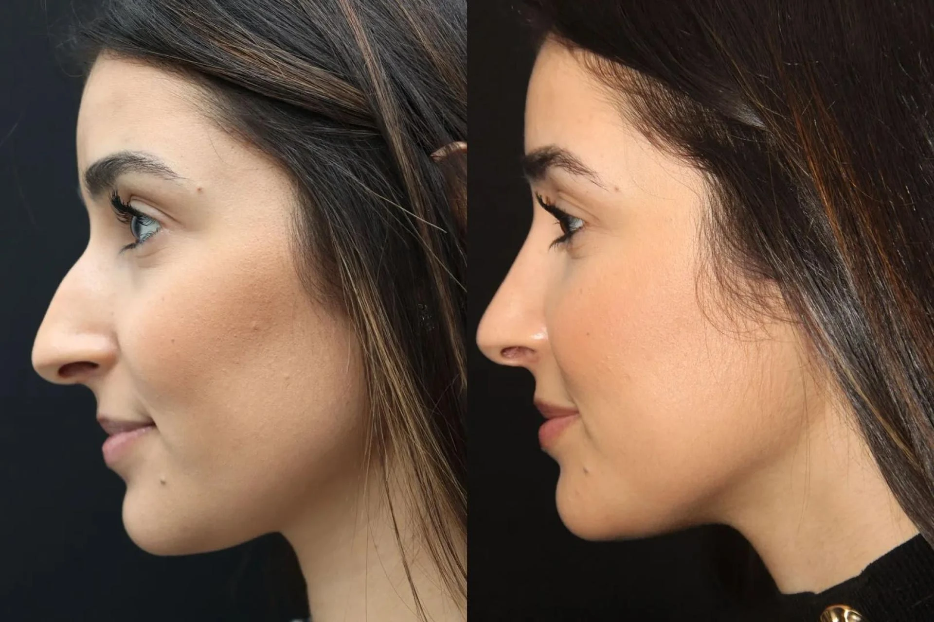 Who Is a Good Candidate for Rhinoplasty?