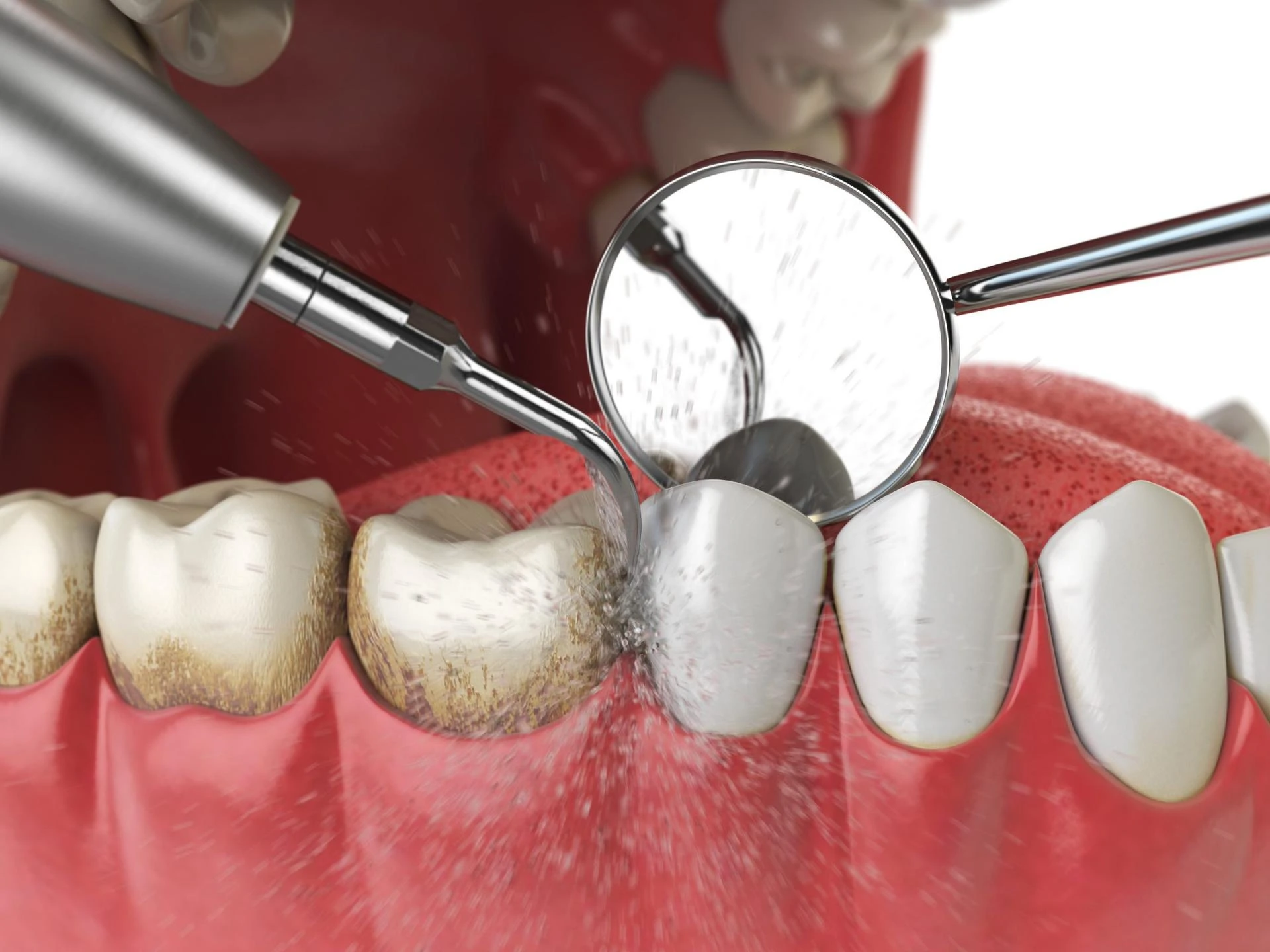 Why Periodontal Maintenance Is Essential After Gum Treatment