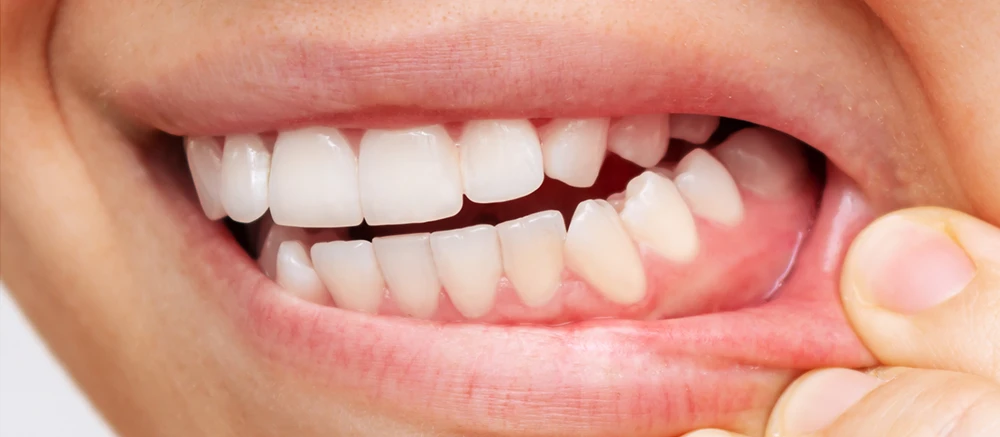Why Prioritizing Gum Health is Essential for a Healthy Smile in Coimbatore