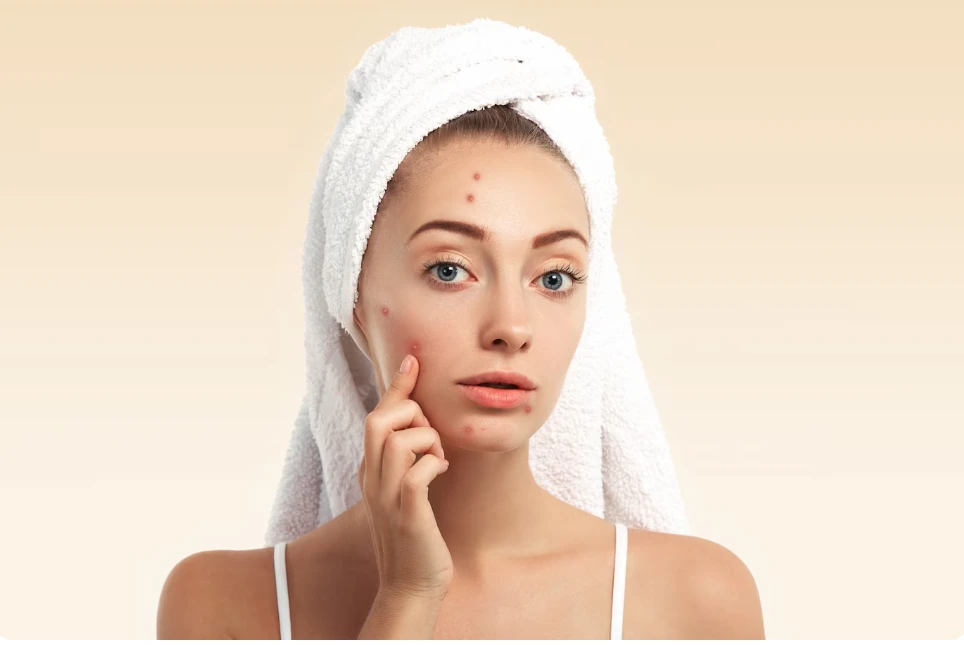 10 Tips Para Mawala ang Pimples: A Science-Backed Guide by Nation Lifestyle