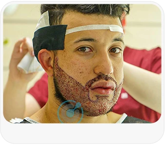 Who Is the Ideal Candidate for an FUE Beard Transplant