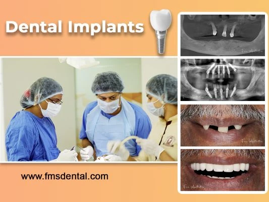 Dental Implant Cost in Hyderabad | Advanced Tooth Replacement 