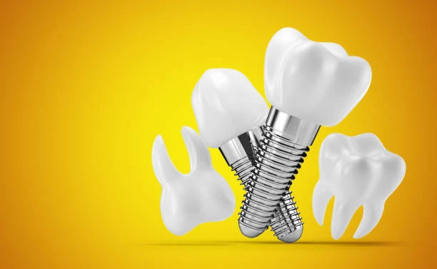 How Long Does a Dental Implant Last? Maintenance Tips for Longevity