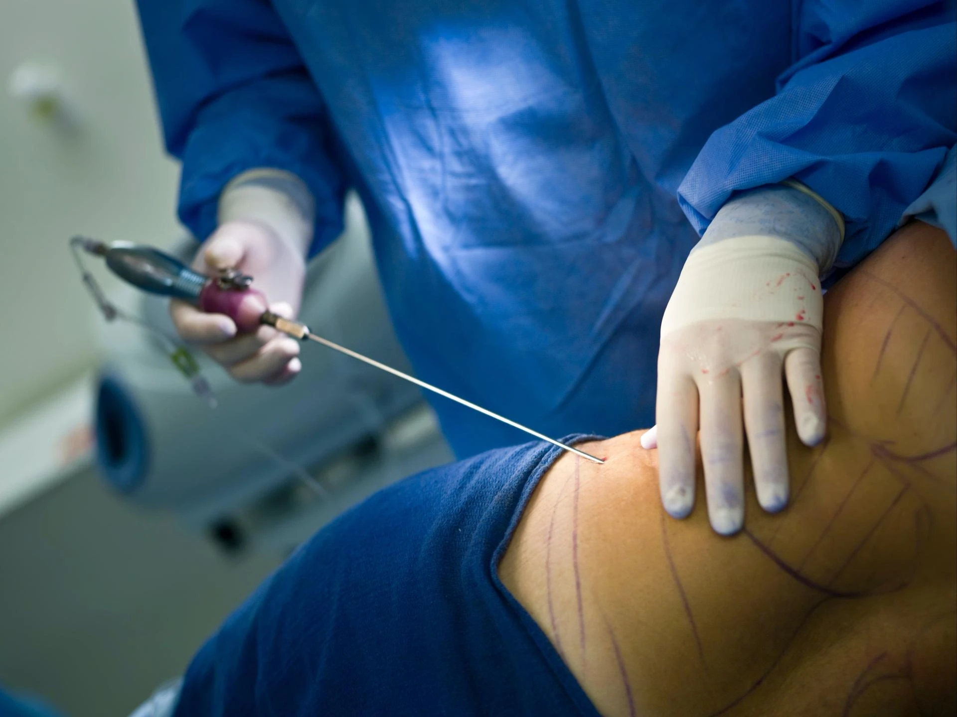 Age and Liposuction: Is There an Ideal Age?