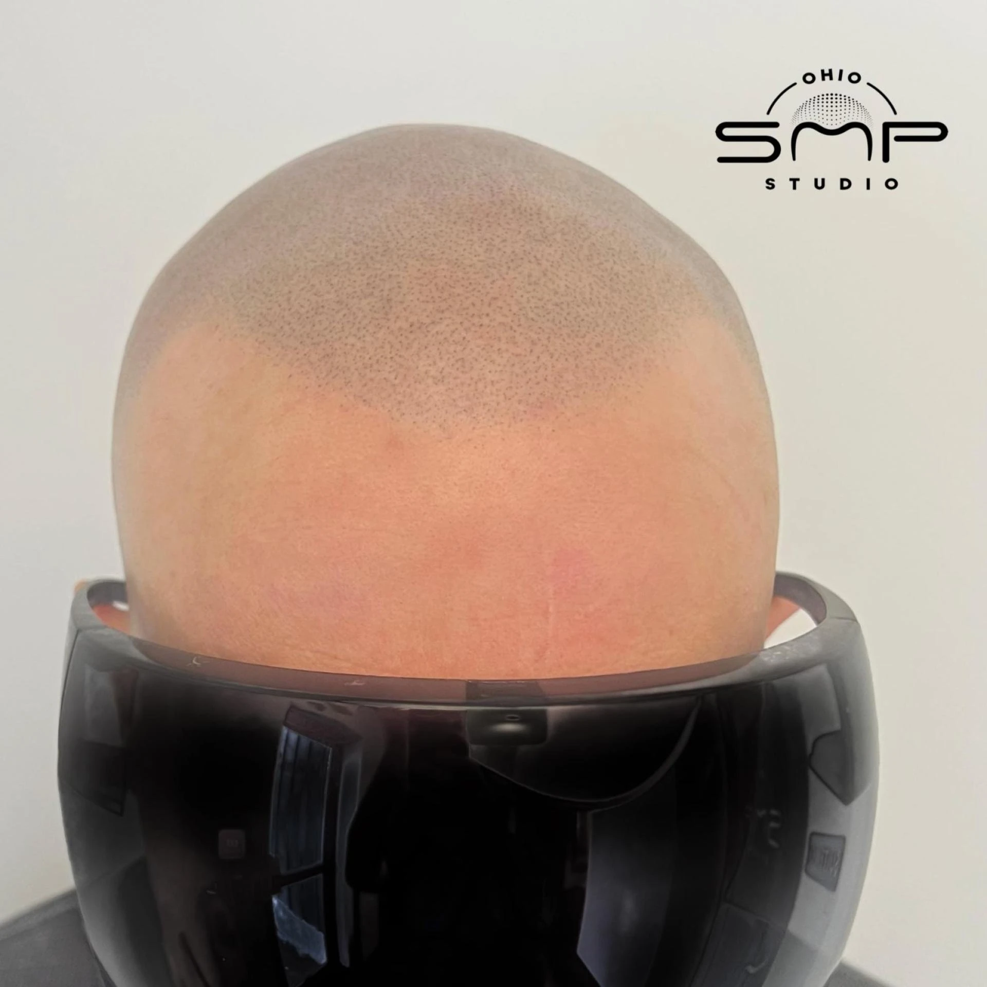 Scalp Micropigmentation: A Cutting-Edge Hair Loss Solution
