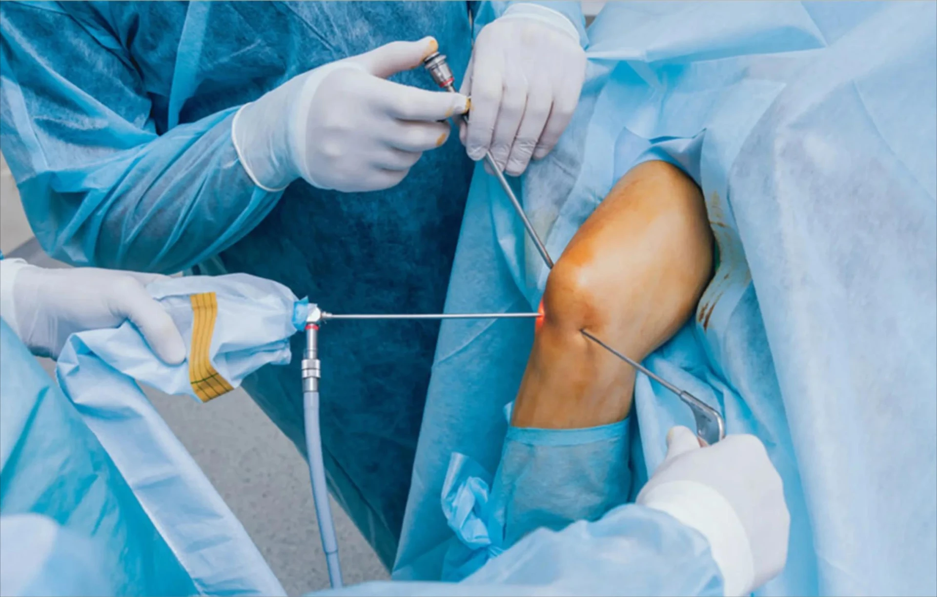 Best Arthroscopy Surgery Delhi: Advanced Keyhole Treatment for Joint Pain