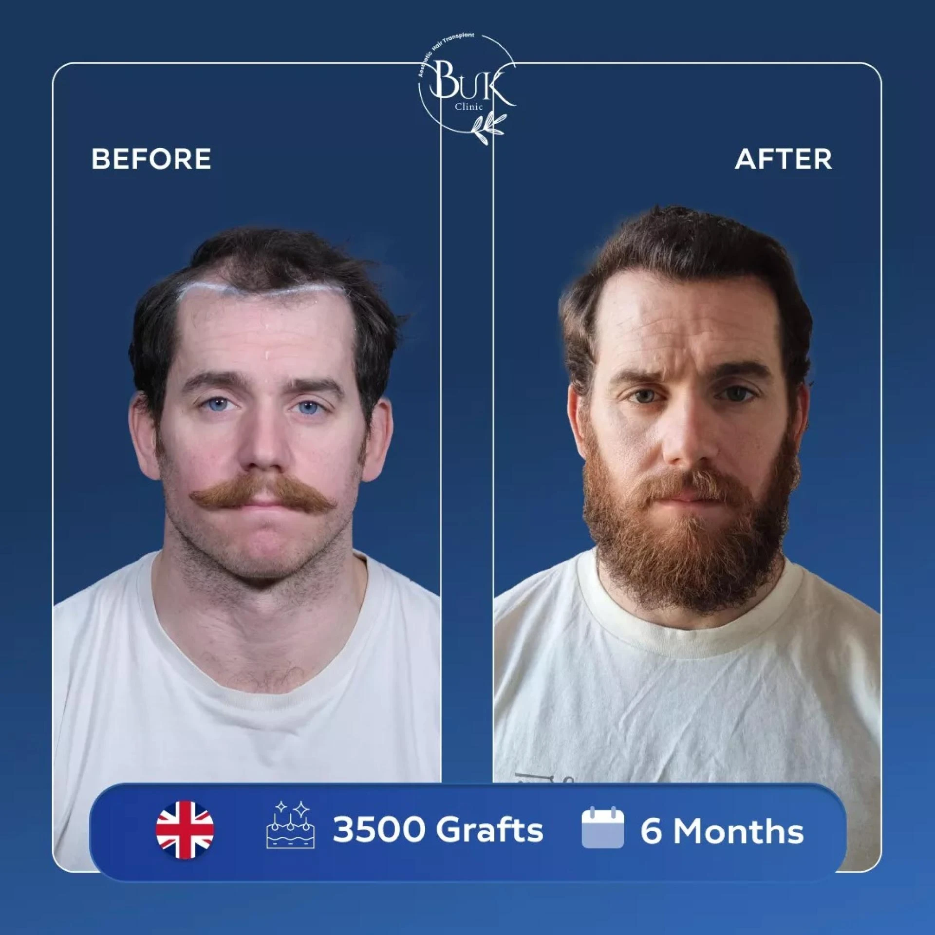 Hair Transplant Turkey: Understanding Hair Loss Causes