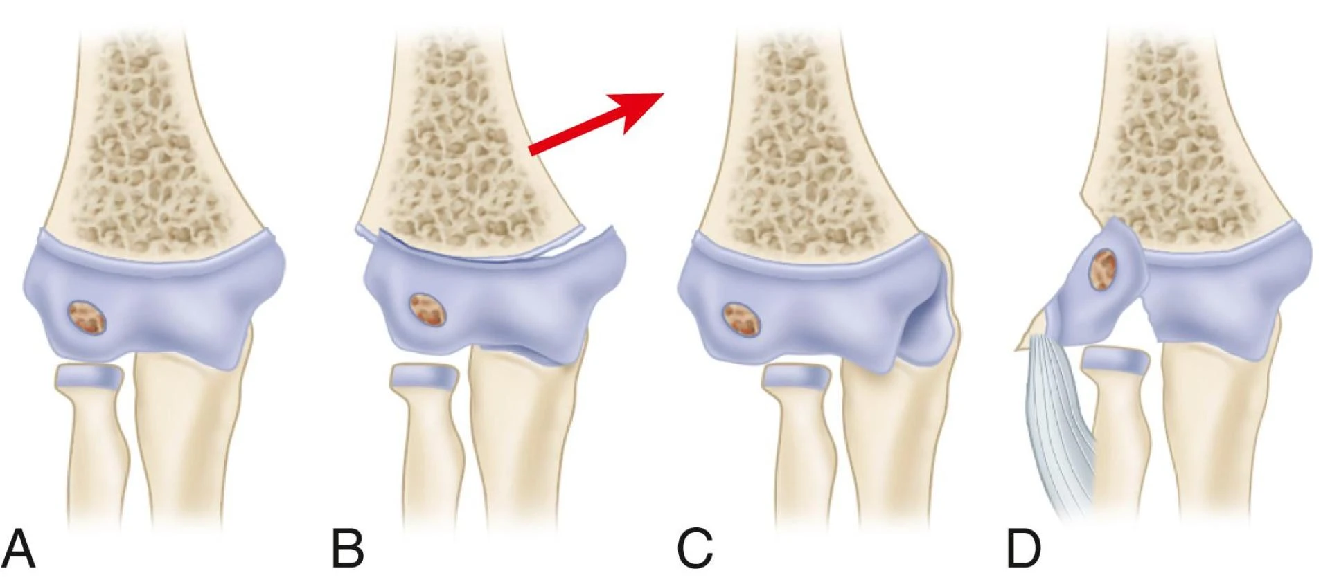 Fractures & Dislocations: Complete Guide to Bone Injuries